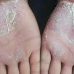 Народне лікування псоріазу лікувати псоріаз дьогтем