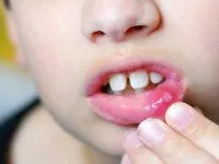 як лікувати стоматит маслом обліпихи