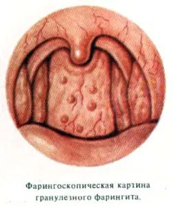 як вилікувати гранульований фарингіт