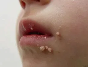як лікувати папіломи у дітей