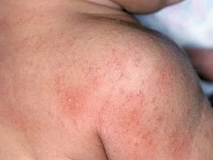 як лікувати дерматит