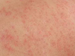 як лікувати дерматит
