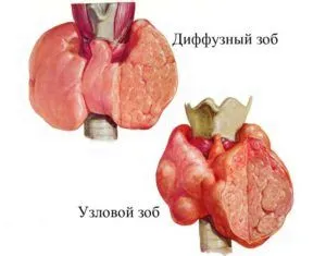 як лікувати хворобу зоб