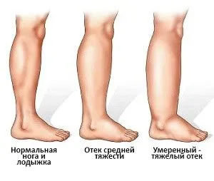 лікувати набряклість ніг