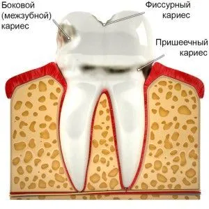 лікувати карієс молочних зубів