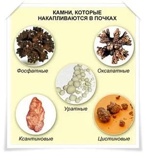 як вилікувати камені з нирок