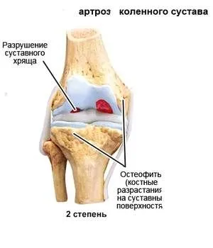як лікувати артроз 2 ступеня