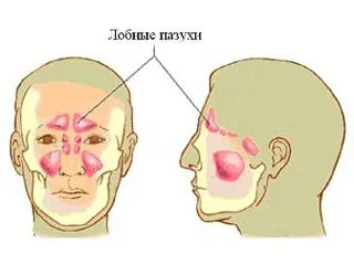 як лікувати гострий фронтит