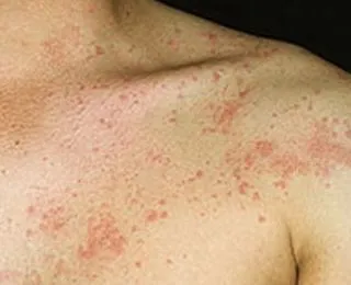 як лікувати нервову кропив'янку