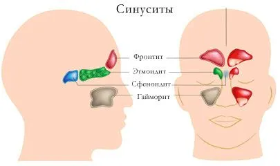 як лікувати синусит ліки