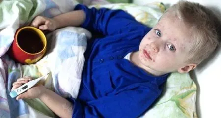 чи можна вилікувати вітрянку за 4 дні