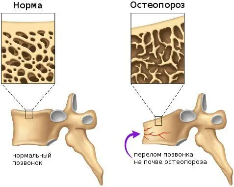 як лікувати остеопороз