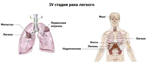 як вилікувати рак 4 ступеня