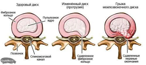 чи можна вилікувати спину