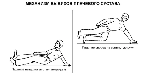 як лікувати розтягнення і вивих