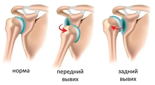 як лікувати розтягнення і вивих