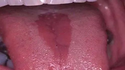 як лікувати хворий мову