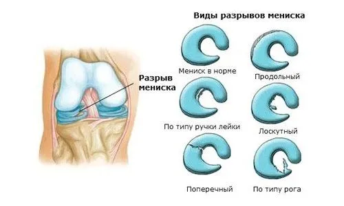 лікувати меніск народними засобами