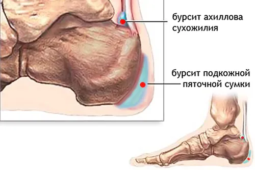 як лікувати п'ятковий бурсит народними засобами