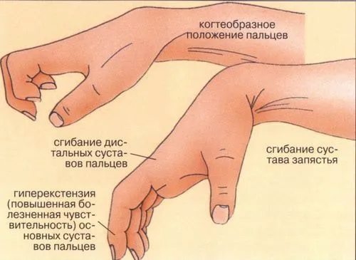 як лікувати розтягнення і вивих