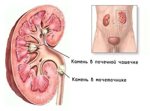 Камені в нирках камені