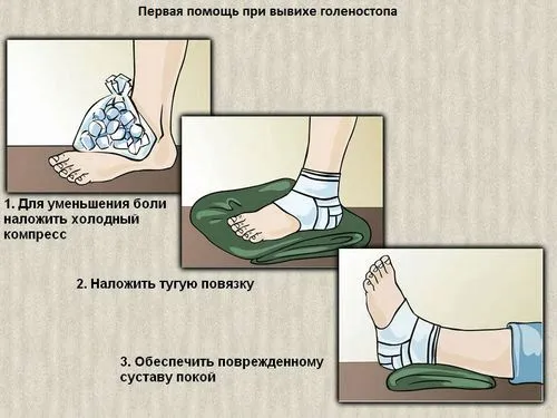 як лікувати розтягнення і вивих