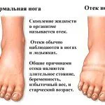 лікувати набряклість ніг
