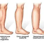 лікувати набряклість ніг
