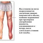 лікувати набряклість ніг