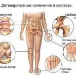 як лікувати артрит ніг