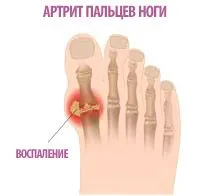 артрит суглобів пальців ніг симптоми лікування