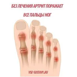 як лікувати суглоб великого пальця ноги