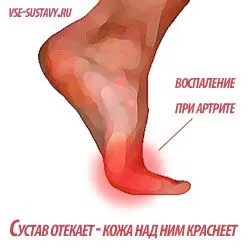 як лікувати суглоб великого пальця ноги