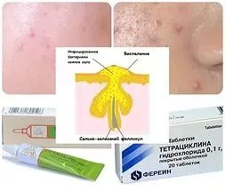 як лікувати прищі тетрациклиновой маззю