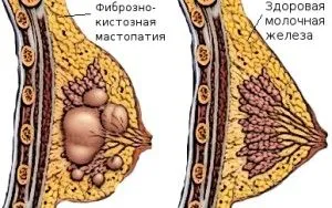 вилікувати мастопатію назавжди