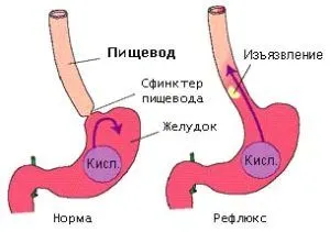 як лікувати печію шлунка