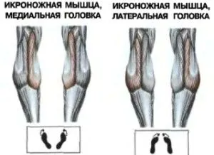 розтягнення литкового м'яза симптоми лікування зв'язок що