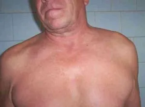 вивих ключиці симптоми