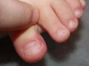 як вилікувати врослий ніготь будинку