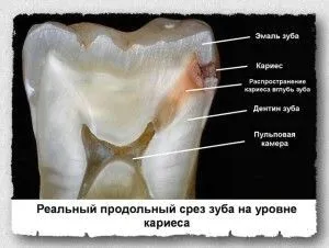 як лікувати середній карієс