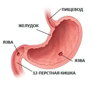 як лікувати шлунок виразка