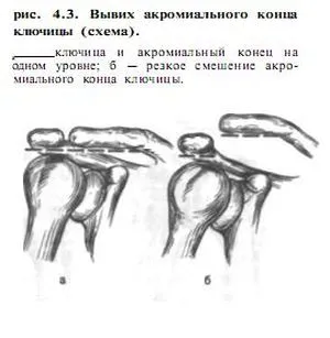 вивих ключиці симптоми