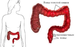 пронос температура дорослий лікування причина