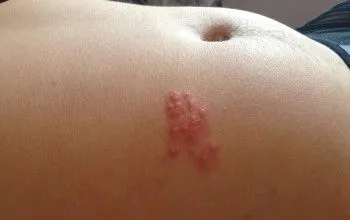 прищі на животі у чоловіків жінок і дітей причини появи лікування профілактика фото