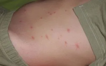 прищі на животі у чоловіків жінок і дітей причини появи лікування профілактика фото