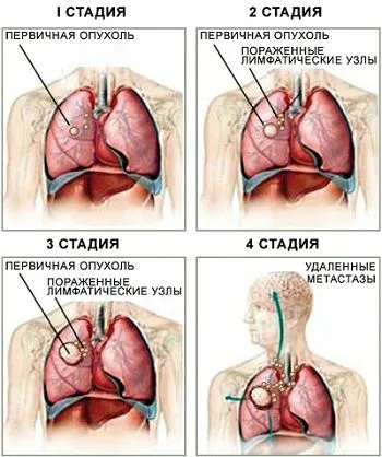 рак легенів скільки можна прожити