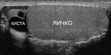 висічення кісти придатка яєчка