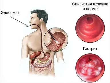 симптоми