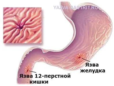 як лікувати гастрит дванадцятипалої кишки