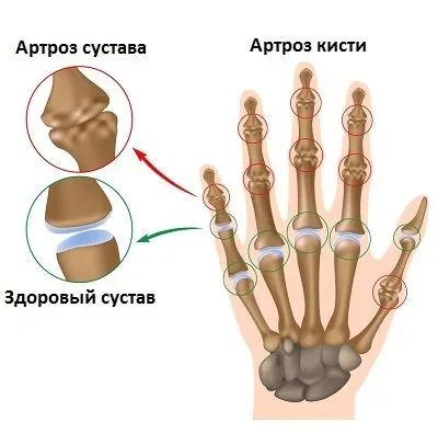 вилікувати артроз будинку